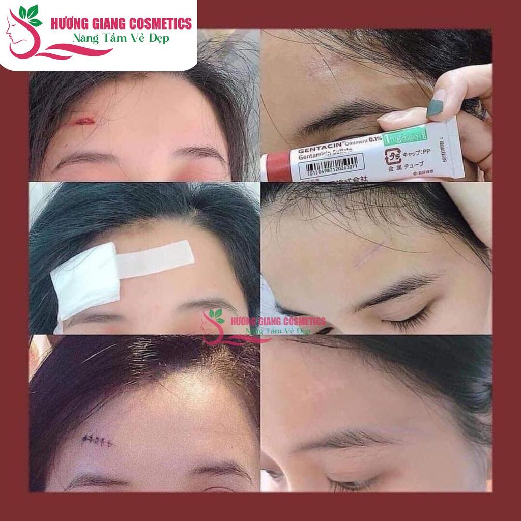 Kem Dưỡng Gentacin Nhật Hỗ Trợ Làm Mờ Sẹo Lồi Lõm 10g
