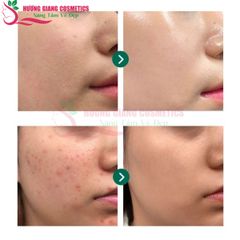 Sữa rửa mặt ngừa mụn The Nature Book Hàn Quốc 120ml