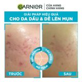  Tinh Chất Garnier Giảm Mụn Mờ Thâm Cho Da Dầu, Mụn 30ml 
