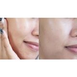  Bộ 2 Sản Phẩm Dùng Thử Cho Da Mụn D Program Acne Set 