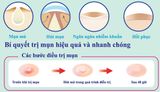  Miếng Dán Mụn Mayan Ultra Thin Spot 20+4 Miếng Ultra Thin Spot Acne Patch 20+4 Patches (0.8cm + 1.0cm) 