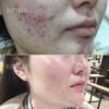 Tinh chất tẩy da chết hóa học So Natural Red Peel Tingle / red peel white Serum 11ml - 35ml