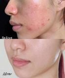 Kem Giảm Thâm La Roche-PoSay Cicaplast B5 40ml