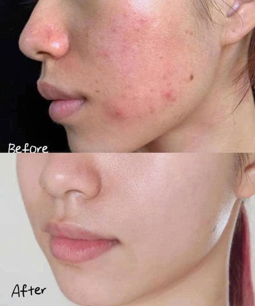 Kem Giảm Thâm La Roche-PoSay Cicaplast B5 40ml