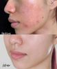 Kem Giảm Thâm La Roche-PoSay Cicaplast B5 40ml