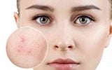Gel Hỗ Trợ Giảm Mụn Mờ Thâm Acne DermaX Derma Gel Tuýp 18g