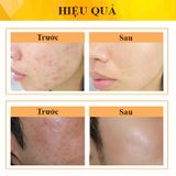 KEM Derma Forte Topical Gel 15g Hỗ Trợ Giảm Mụn, Giảm Thâm