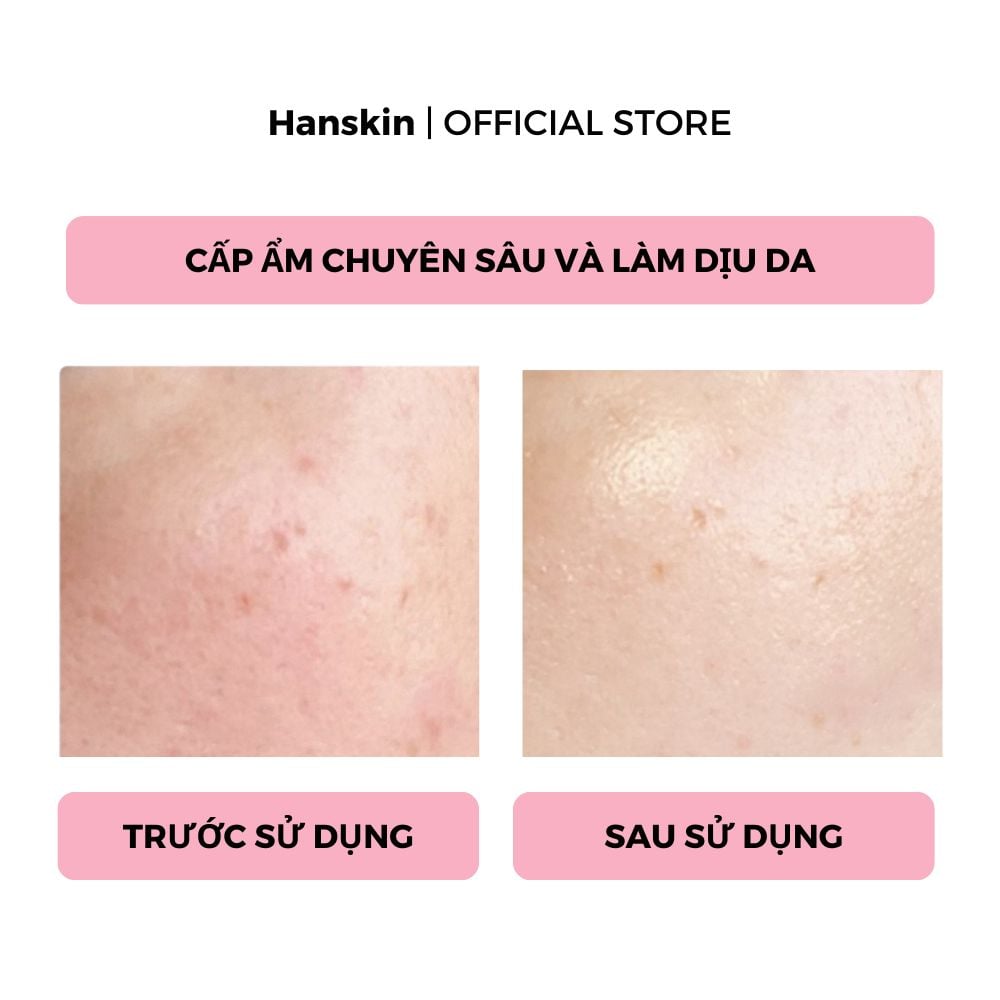 Combo Toner pad cấp ẩm làm dịu da Hanskin & Tinh Chất Dưỡng Sáng Da Hanskin Clearing Niacin Ampoule