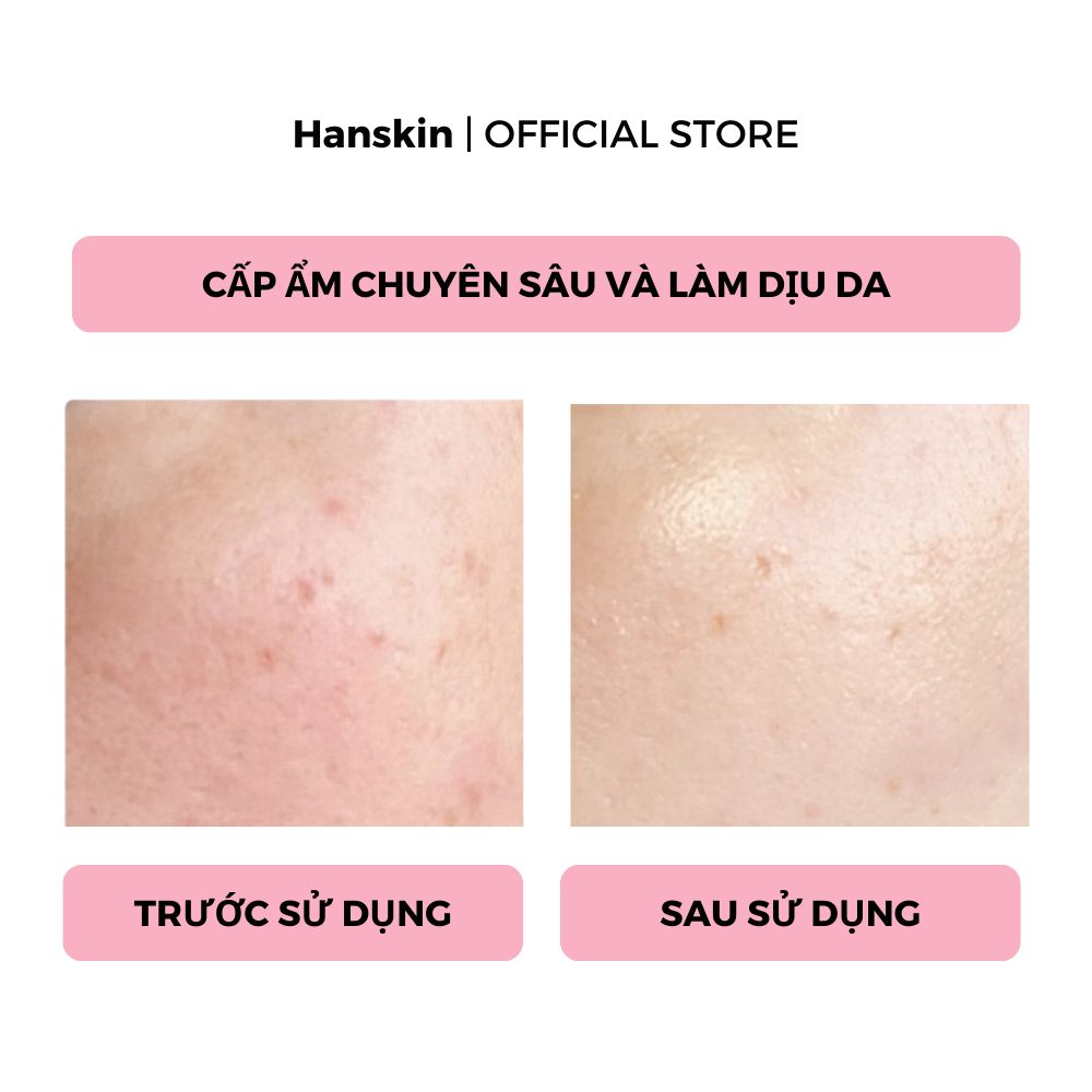 Combo Toner Pad Cấp Ẩm Làm Dịu Da Hanskin & Phấn Nước Trang Điểm Hanskin Blemish Cover Cushion