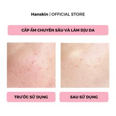Combo Nước Hoa Hồng Hanskin 300ml & Toner Pad Cấp ẩm Hanskin 210ml