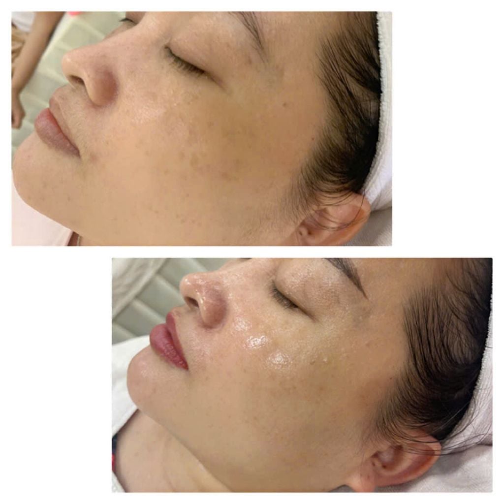  Liệu trình điều trị nám MELA Complex 