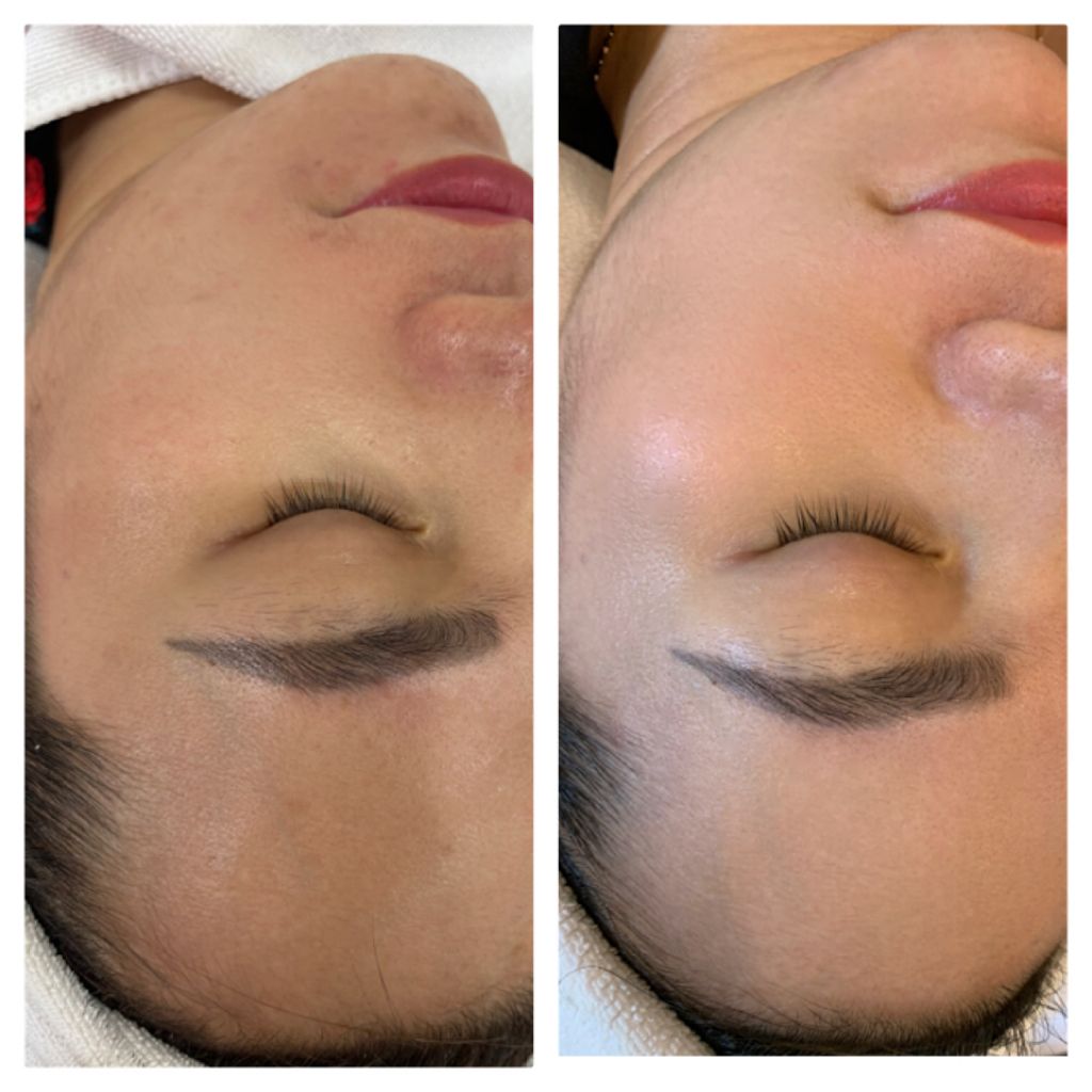  Làm Sạch Sâu Deep Cleansing - Đánh Bay Mụn Ẩn 