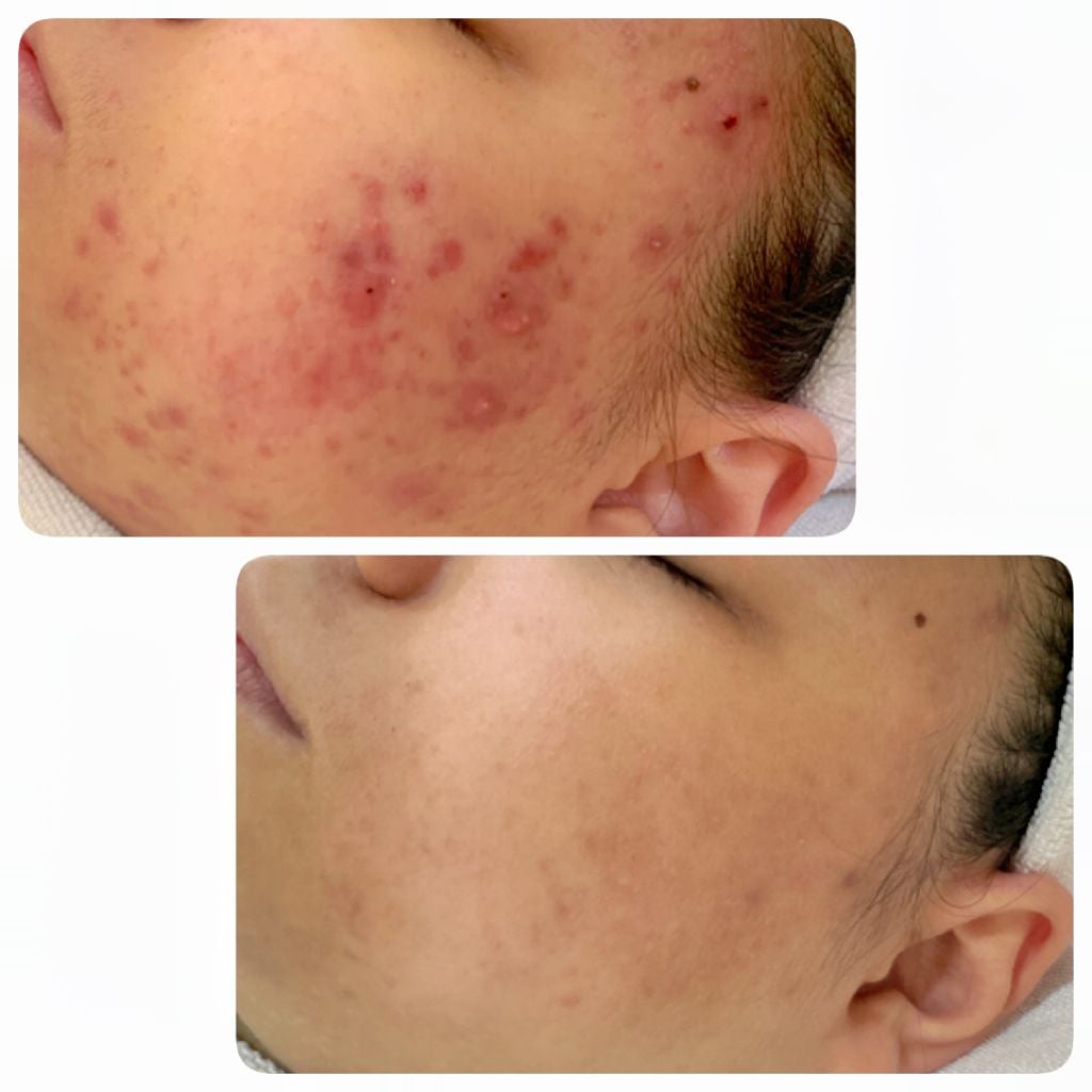  Kháng khuẩn đa tầng 