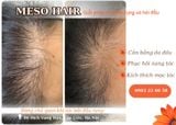  Liệu Trình Meso Hair 