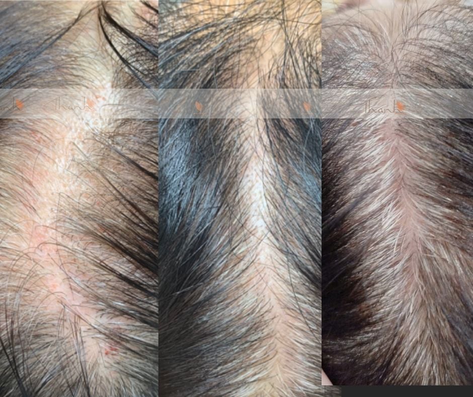  Liệu Trình Meso Hair 