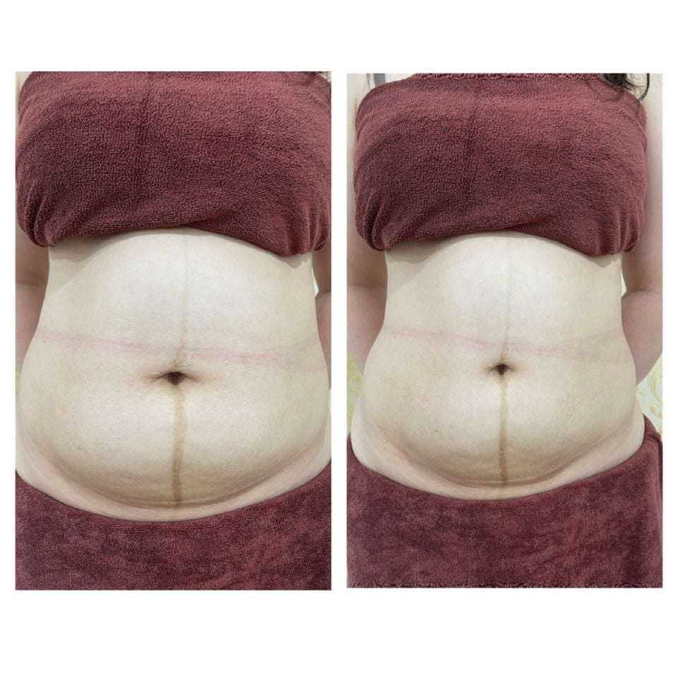  Liệu Trình Giảm Béo Dưỡng Sinh 