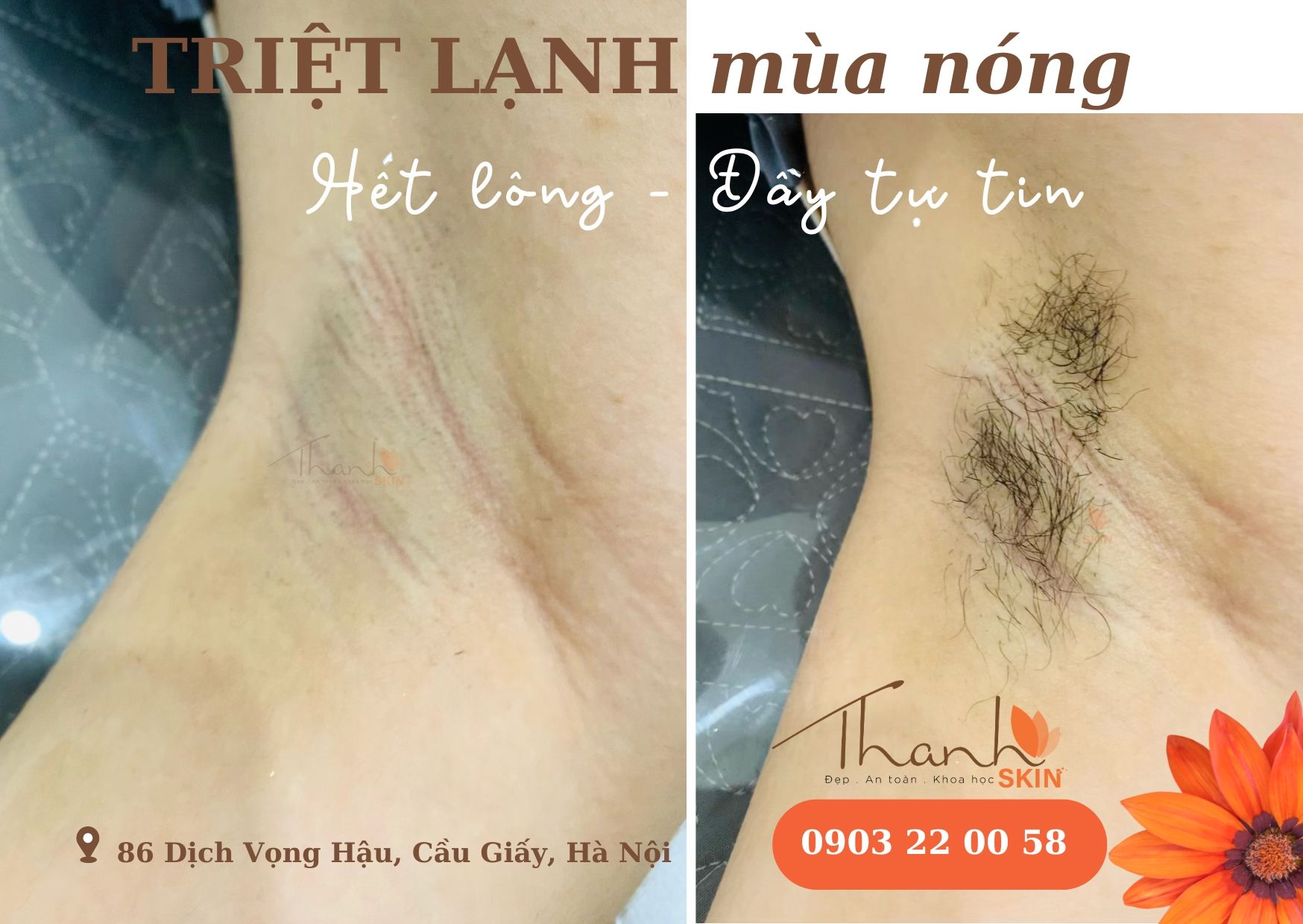  Liệu Trình Triệt Lông Lạnh 