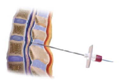 Bộ Khăn Gây Tê Màng Cứng 