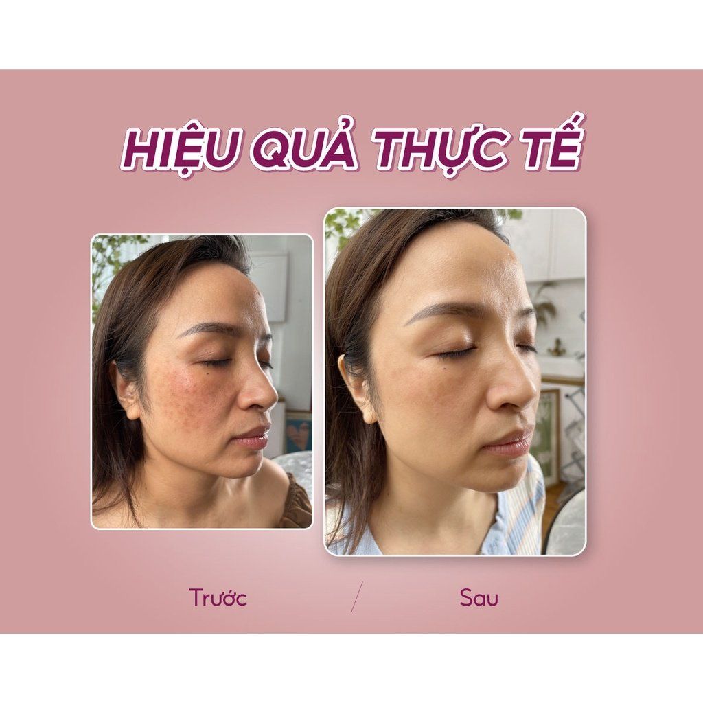Tinh chất mờ nám và tàn nhang dưỡng trắng da OMUSE MelaV White Serum 30ml