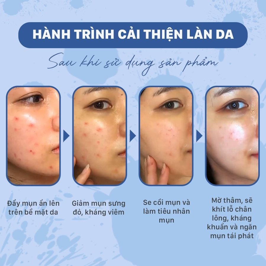 Serum giảm mụn chứa Bakuchiol cho da dầu mụn OMUSE Blemish Solution Acne Correcting Serum 30ml