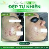  Dịch vụ điều trị mụn 