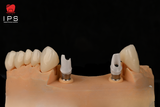  Phục hình sứ trên implant - Cutomized abutment sứ trên tibase 
