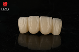  Phục hình sứ trên implant - Cutomized abutment sứ trên tibase 