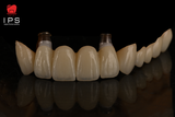  Phục hình sứ trên implant - Cutomized abutment sứ trên tibase 