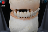  Phục hình sứ trên implant - Cutomized abutment sứ trên tibase 