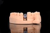  Phục hình sứ trên implant - Customized Abutment 