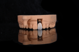  Phục hình sứ trên implant - Customized Abutment 
