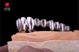  Phục hình sứ trên implant - Sứ Crom Cobalt Digital 