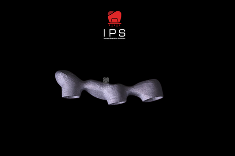 Phục hình sứ trên implant - Sứ Crom Cobalt Digital 