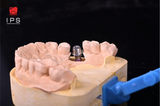  Phục hình sứ trên implant - Customized Abutment 