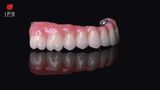  Phục hình sứ trên implant - Sứ full Zirconia 