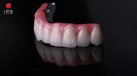  Phục hình sứ trên implant - Sứ full Zirconia 