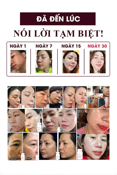 Combo Zin NMN - Trắng Không Tì Vết, Mờ Sạm Nám, Tàn Nhang Zin NMN