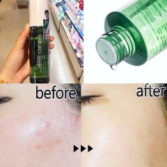 Nước hoa hồng Naruko tea tree shine control 150ml