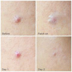 Miếng dán mụn Some By Mi Clear Spot Patch