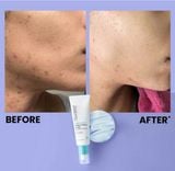  Chấm mụn của Mỹ, Benzoyl Peroxide ( BPO ) 5% của Urban Skin Rx Mỹ giảm mụn sưng viêm có nhân mụn trứng cá 
