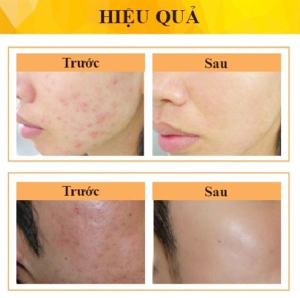 Gel Dưỡng Alcom DERMA FORTE Hỗ Trợ Giảm Mụn, Giảm Thâm 15g