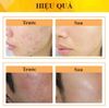 Gel Dưỡng Alcom DERMA FORTE Hỗ Trợ Giảm Mụn, Giảm Thâm 15g