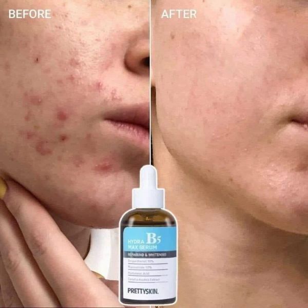 (CÔNG TY) Tinh Chất Prettyskin Hydra Max Serum B5 Phục Hồi, Dưỡng Trắng Da 50ml