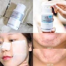 Nước Hoa Hồng OBAGI Clenziderm MD Pore Therapy Giảm Mụn 148ml
