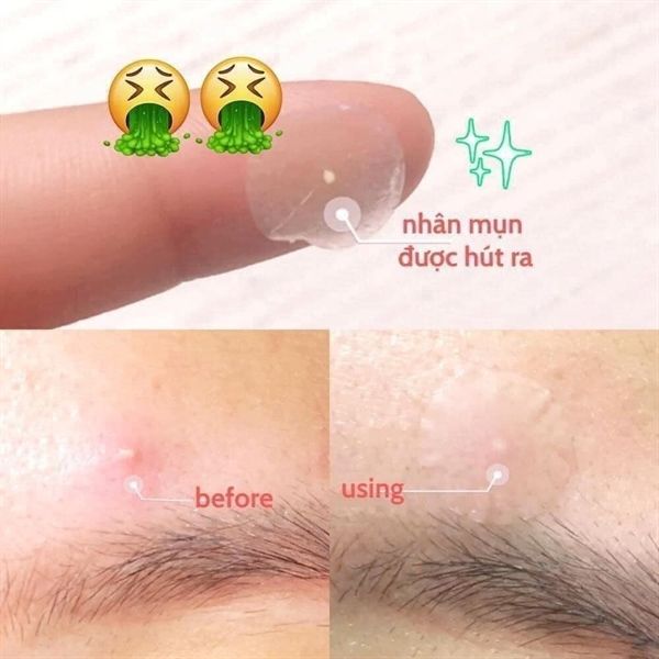 Miếng Dán Mụn Some By Mi 30 Days Miracle Clear Spot Patch (18 pcs)