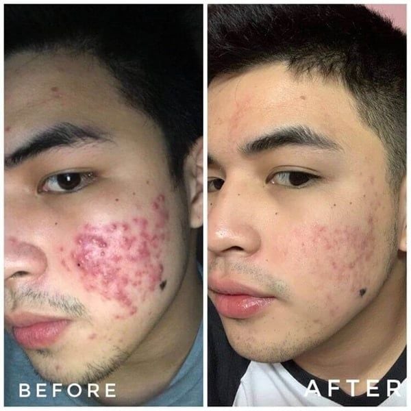 Serum trị mụn Lumos Acne 5ML