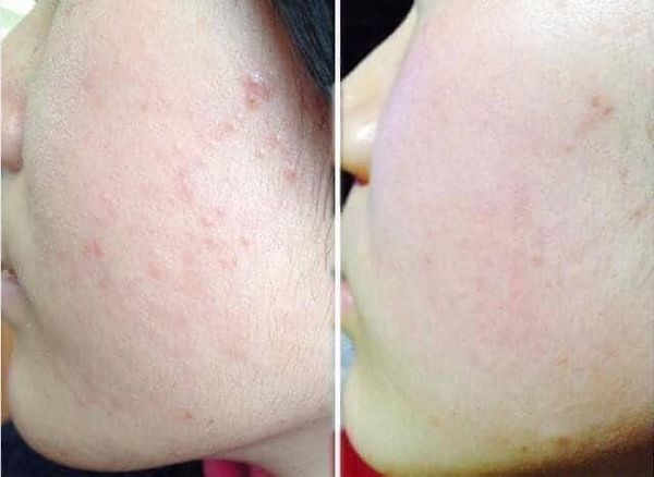 Gel trị mụn Sato Dalacin T Gel 1% (10g)