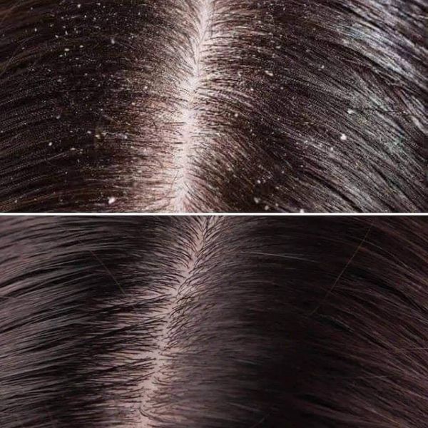 Dầu Gội Head & Shoulders Làm Sạch Gàu Cho Mọi Loại Tóc 400ml Clinical Strength Dandruff Shampoo