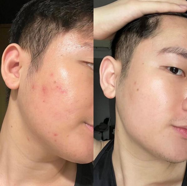 Gel trị mụn Sato Dalacin T Gel 1% (10g)