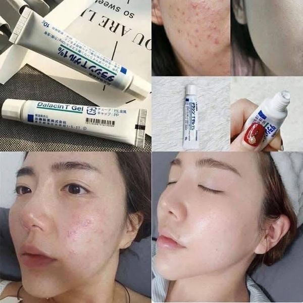 Gel trị mụn Sato Dalacin T Gel 1% (10g)